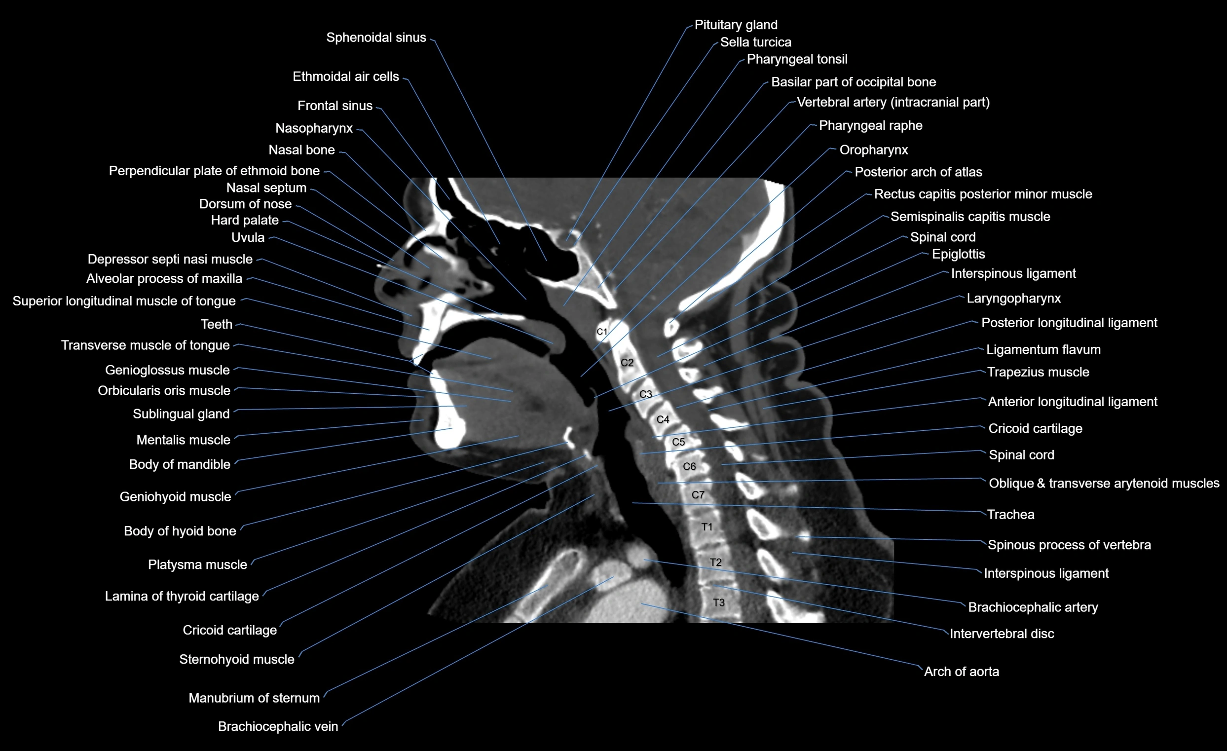 Neck CT sagittal cross sectional anatomy 3D  radiology  image-img-00001-00001.webp